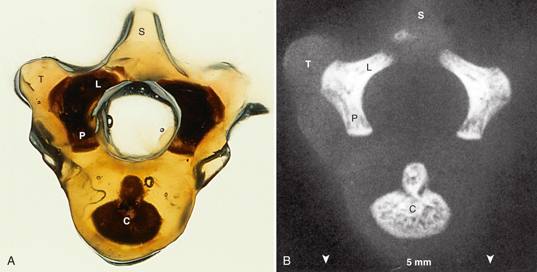 FIG. 35.4, Vertebral Ossification of T9 at 16 Weeks' Gestation.