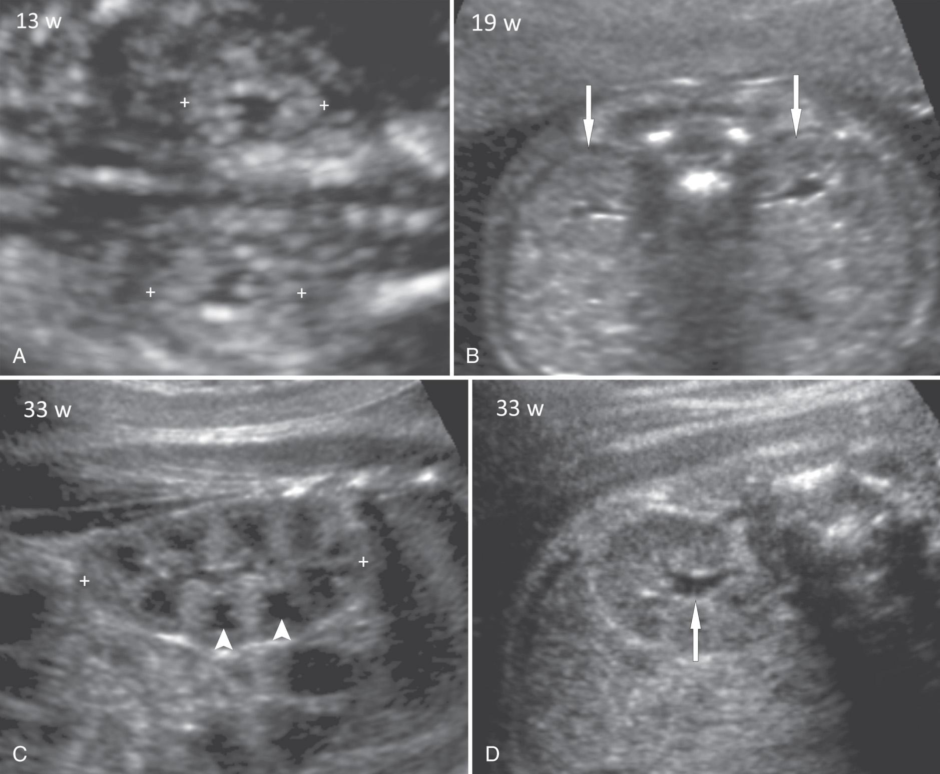 FIG. 39.2, Normal Sonographic Appearance of Kidneys at Different Gestational Ages.