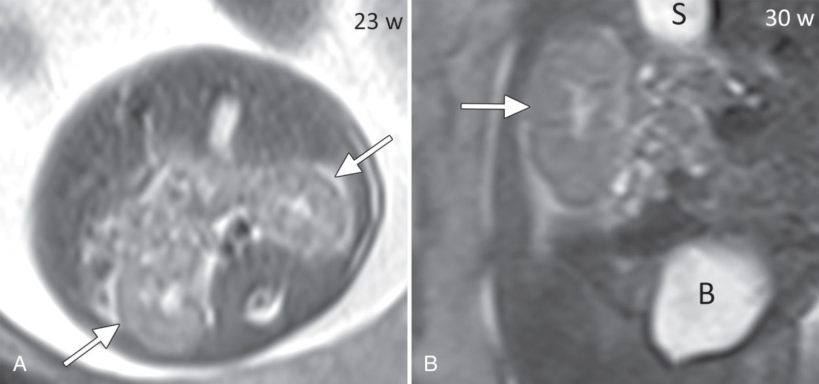 FIG. 39.4, Magnetic Resonance Images of Normal Kidneys.