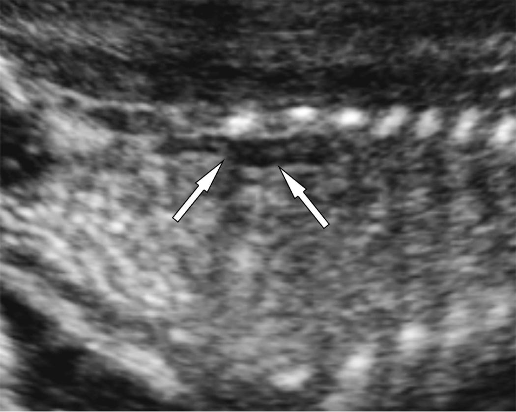 FIG. 39.5, “Lying Down” Adrenal Sign.