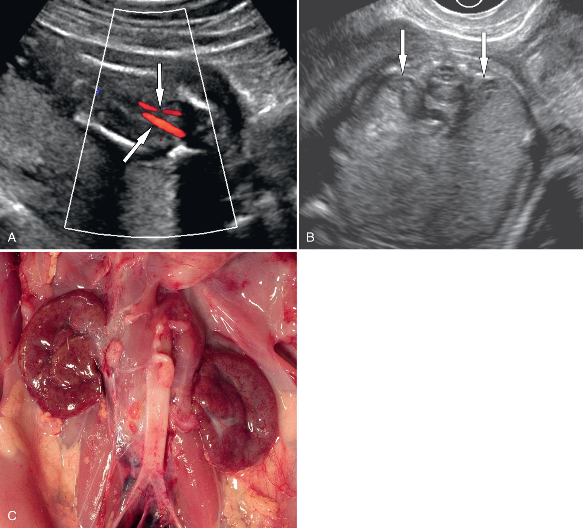 FIG. 39.6, Bilateral Renal Agenesis.