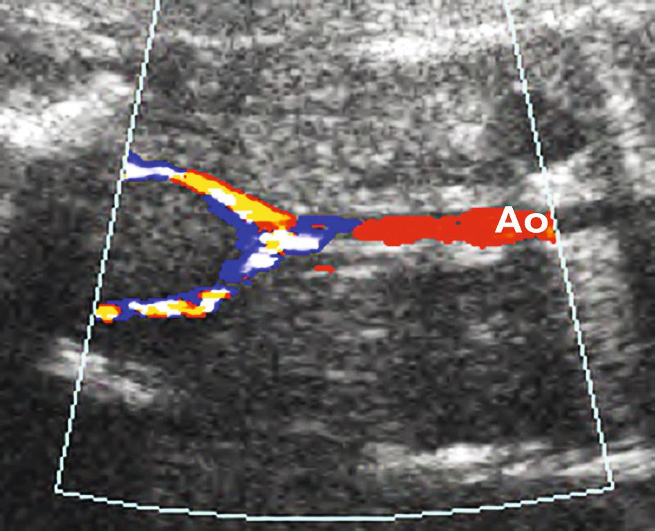 FIG. 39.7, Absent Renal Arteries.