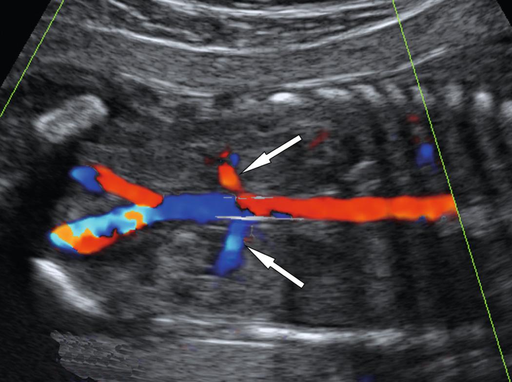 FIG. 39.8, Normal Renal Arteries.