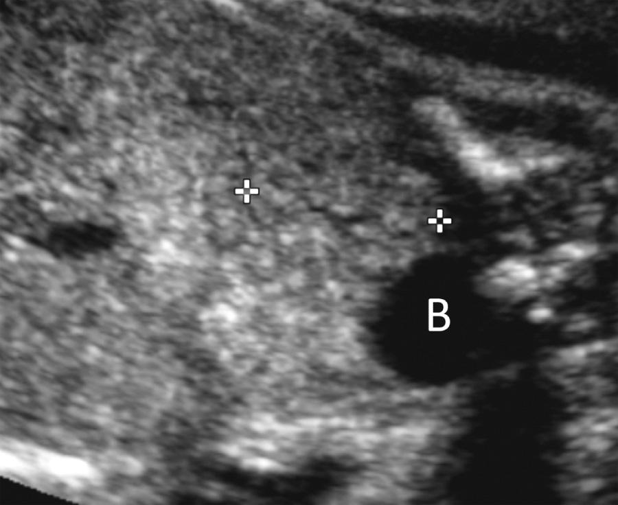 FIG. 39.9, Pelvic Kidney.