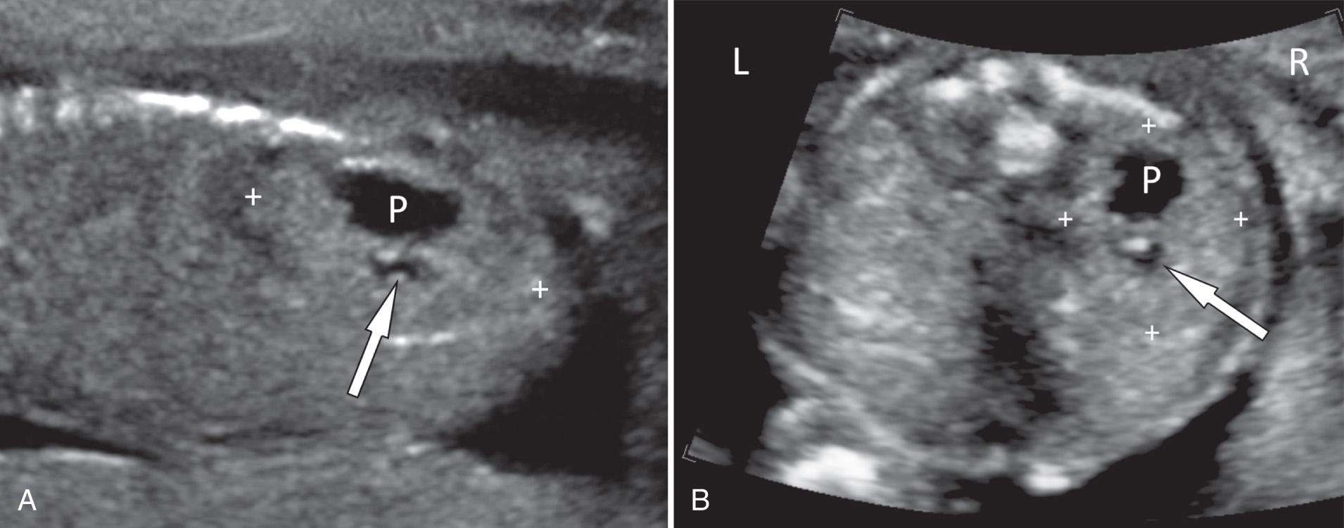 FIG. 39.10, Cross-Fused Renal Ectopia.