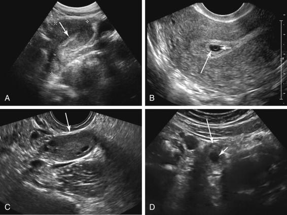 F igure 14-1, Transabdominal (TA) versus transvaginal (TV) sonography in early pregnancy. A, Midline longitudinal TA image of the uterus (cursors) shows no evidence of a gestational sac (arrow) . B, Longitudinal TV sonogram of the uterus in the same patient as in image A shows a small intrauterine gestational sac (long arrow) containing a yolk sac (short arrow) . TV imaging facilitated a definitive diagnosis of an intrauterine pregnancy that was not possible with the TA approach. C, TV image of the right adnexal region in a different patient shows a normal appearing ovary (arrow) . No ectopic pregnancy was visualized. D, Axial TA image of the right upper pelvis in the same patient as in image C shows an echogenic adnexal ring (long arrow) surrounding a gestational sac (short arrow) that was confirmed to be an ectopic pregnancy at surgery. The ectopic pregnancy could not be visualized at TV ultrasound because it was located high in the pelvis, beyond the field of view of the TV probe.