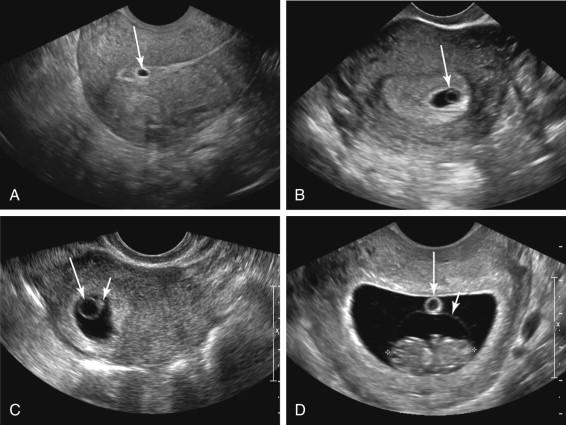 F igure 14-2, Progression of ultrasound findings during normal first trimester. A, Longitudinal transvaginal (TV) image of the uterus shows an early intrauterine gestational sac (arrow) . B, Axial TV image of the uterus shows a yolk sac (arrow) in the gestational sac. The yolk sac is the first normal structure identified in the gestational sac. C, Oblique TV image of the uterus shows the early embryo as a focal thickening (short arrow) along the outer margin of the yolk sac (long arrow) . The embryo is visualized after the yolk sac and should be located adjacent to the yolk sac when first seen. D, Axial TV image of the uterus at 9 weeks gestation shows the yolk sac (long arrow) separate from the embryo (cursors) in the chorionic cavity, outside the amnion (short arrow) .