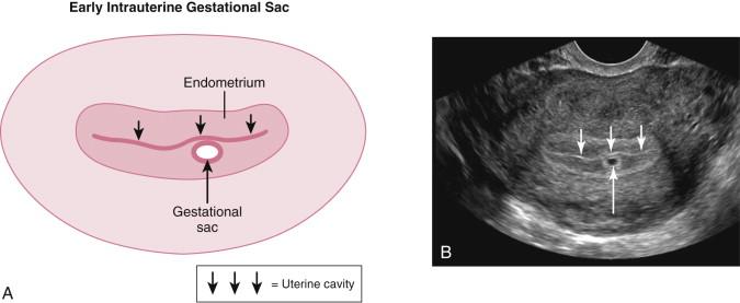 F igure 14-3, Early intrauterine gestational sac. Schematic representation (A) and corresponding transvaginal ultrasound image (B) of the uterus show a small, rounded fluid collection surrounded by a well-defined, thick, peripheral rim of echogenic tissue (long arrows) , consistent with an early intrauterine gestational sac. Note the characteristic location of the gestational sac immediately adjacent to, but distinct from, the uterine cavity (short arrows) . This appearance has been termed the intradecidual sign.