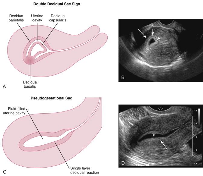 F igure 14-4, Double decidual sac sign versus pseudogestational sac. A and B, Double decidual sac sign. Schematic representation of the double decidual sac sign (A) and the corresponding longitudinal transvaginal ultrasound image (B) depict three layers of echogenicity surrounding most of an intrauterine gestational sac. The layers correspond to decidua on both sides of the uterine cavity, with the uterine cavity in between the layers. The inner echogenic layer (arrowhead) , termed the decidua capsularis , directly surrounds the gestational sac. The outer layer, termed the decidua parietalis (long white arrow), is on the opposite side of the uterine cavity. The uterine cavity (short arrow) is the hypoechoic layer between the echogenic layers. The three-layer appearance is not seen at the site of implantation (decidua basalis). C and D, Pseudogestational sac. Schematic representation (C) and the corresponding longitudinal transvaginal ultrasound image (D) of the uterus of a patient with an ectopic pregnancy depict a pseudogestational sac comprised of fluid in the uterine cavity (F) surrounded by a single echogenic layer of decidua (arrow) .