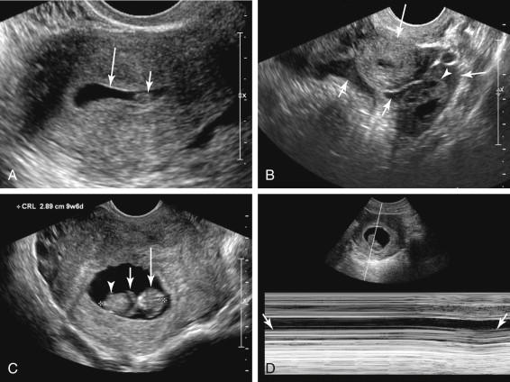 F igure 14-5, Pitfall: Intrauterine embryo versus pseudogestational sac with clotted blood. A and B, Clotted blood in the pseudogestational sac resembles an embryo. A, Axial transvaginal (TV) image of the uterus in a patient with an ectopic pregnancy shows a fluid collection (long arrow) containing a focus of clotted blood (short arrow) initially thought to represent an embryo. No cardiac activity was seen. B, Image of the left pelvis in the same patient as in image A shows an ectopic pregnancy (long arrow) medial to the left ovary (arrowhead) . Free fluid with internal echoes due to pelvic hemoperitoneum (short arrows) was also identified. C and D, Nonviable embryo. Image of the embryo (C) in a different patient shows head (long arrow) , arm buds (short arrow) , and body (arrowhead) as well as crown-rump length measurement consistent with 9 weeks 6 days. Although no cardiac activity was identified on M mode ( D , arrows ), an intrauterine pregnancy is confirmed because distinct body parts are visualized. Findings are consistent with intrauterine embryonic demise, as a nonviable pregnancy can be diagnosed when no cardiac activity is identified and crown-rump length is 7 mm or greater.