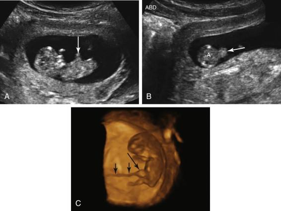 F igure 14-6, Physiologic gut herniation. A, Sagittal image of the embryo shows a focal, rounded, solid structure protruding anteriorly from the abdomen (arrow) at the expected site of the umbilical cord insertion. B, Axial image at the level of the fetal abdomen. Note that the size of the herniation (arrow) is significantly smaller than that of the abdomen (A). C, Three-dimensional image of the embryo confirms that the midgut herniation (long arrow) is into the base of the umbilical cord (short arrows) .