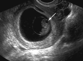 F igure 14-7, Rhombencephalon. Sagittal transvaginal (TV) image of the embryo at 8 weeks gestation shows a cystic structure (arrow) in the posterior portion of the head attributable to the normal embryologic development of the hindbrain. This structure should not be mistaken for an abnormality such as anencephaly, a choroid plexus cyst, or a Dandy-Walker malformation.