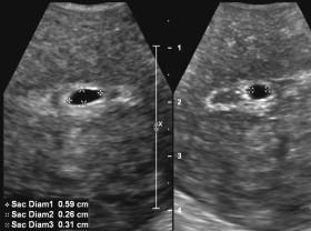 F igure 14-8, Mean gestational sac diameter (MSD) measurement. Longitudinal and axial images of an early intrauterine gestational sac show calipers positioned along the inner wall of the gestational sac in three orthogonal planes to measure the MSD. When the measurements of 0.59, 0.26, and 0.31 are averaged, the result is an MSD of 0.39 cm.