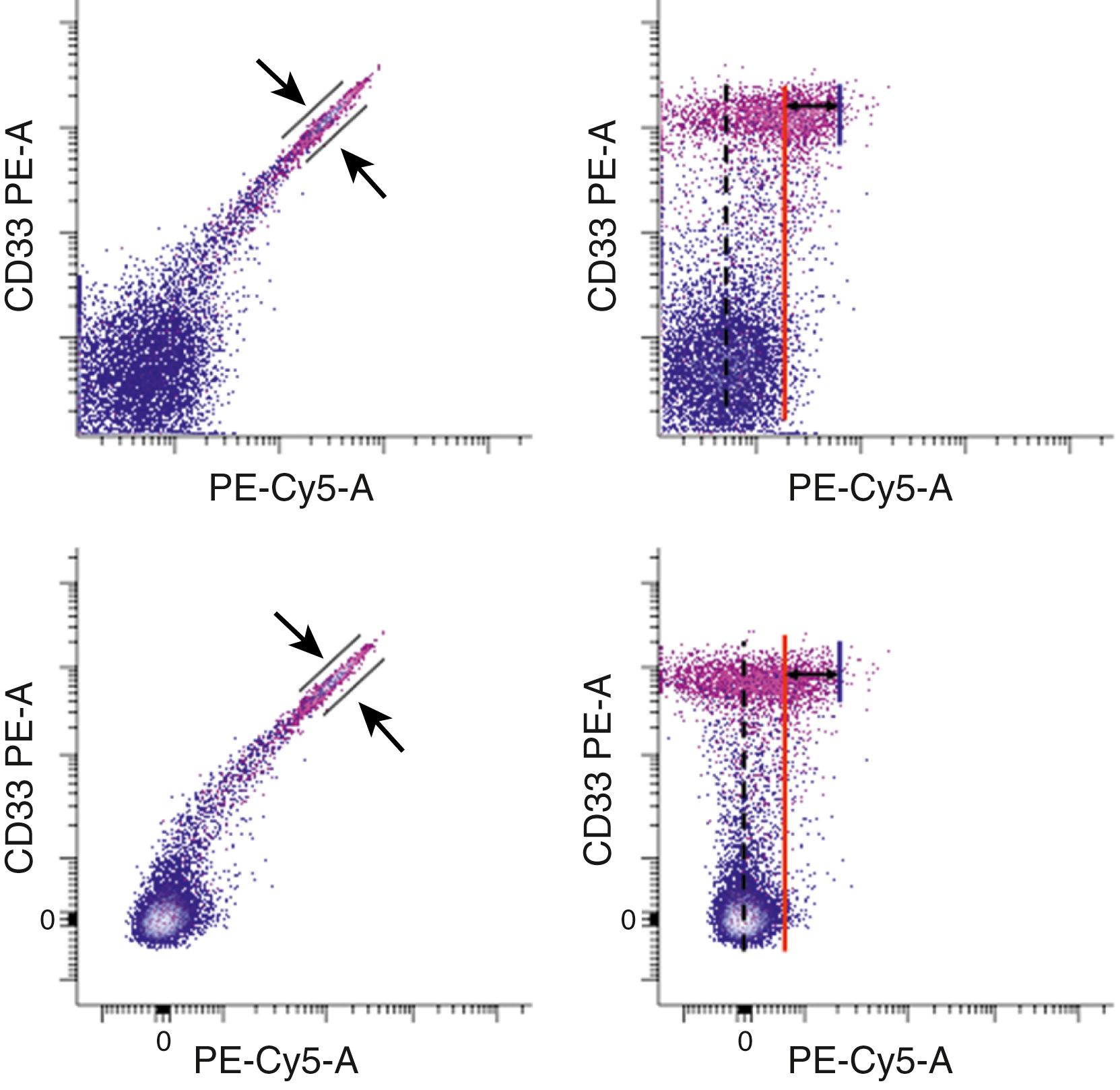 Figure 35.4, Compensation. Dot plots show monocytes (pink) and lymphocytes (blue) singly stained with CD33-PE represented on both a logarithmic scale (top) and a biexponential scale (bottom) . In the logarithmic function, values are undefined at zero; thus, dot plots are unable to display zero or negative values. The biexponential function merges a logarithmic region for higher values with a linear region near zero. Thus, it is able to display both zero and negative values, resulting in a symmetric distribution of data around zero following compensation. The fluorescence emission of CD33-PE appears in both phycoerythrin (PE) and PE-Cy5 detectors as PE emits in both regions of the spectrum examined by these detectors. Note that no PE-Cy5 conjugated antibody is used in this experiment. Without compensation applied (left) , monocytic cells expressing abundant CD33 show bright signals for both PE and PE-Cy5 with the width of the population (black arrows) due to measurement errors inherent in the method. Once compensation is correctly applied (right) , the centers (represented by the dashed line) of the Pe-Cy5 emission for both CD33-positive and CD33-negative populations is the same . In the logarithmic display, both negative and positive populations have the same low level of PE-Cy5 emission, with a similar number of events either to the left of the dashed line or lying on the vertical axis as are to the right of the dashed line in the logarithmic display. The ability to visualize negative values is one reason that a biexponential display is preferred in some situations. The PE-positive population also shows a higher level of apparent PE-Cy5 background fluorescence (short blue line) than the PE-negative population (red line) in both displays, the difference between the two represented by double-headed black arrows . The practical result is that the sensitivity for the detection of low-level PE-Cy5 is compromised in the presence of bright PE fluorescence. For example, if a PE-Cy5 conjugated antibody had been used in this experiment, CD33-positive cells might have been erroneously interpreted as positive for dim PE-Cy5.