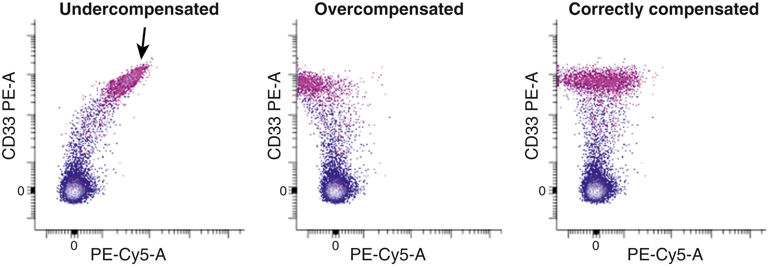 Figure 35.5, Inappropriate compensation. The fluorescence emission of monocytes (pink) singly labeled with CD33-PE shows minimal apparent PE-Cy5 fluorescence when 22% of the PE signal is subtracted from the PE-Cy5 signal (i.e., appropriate compensation or spillover correction, right ) . Note the symmetric distribution of events of about zero for PE-Cy5 when the data are correctly compensated. If the degree of spillover correction is decreased to 15% (left, undercompensated) , the CD33-positive population appears to express dim PE-Cy5 and could be misinterpreted as positive. Note the lack of symmetry for PE-Cy5 with increasing PE fluorescence and the pointed end of the positive population (arrow) as a clue to inaccurate compensation. If the compensation is increased to 26% (middle, overcompensated) , the CD33-positive population has a median PE-Cy5 fluorescence lower than the CD33-negative population, providing a clue that the parameter is overcompensated. If one were using a logarithmic scale, the CD33-positive population would be compressed on the x -axis and, depending on the degree of overcompensation, might appear not to exist.