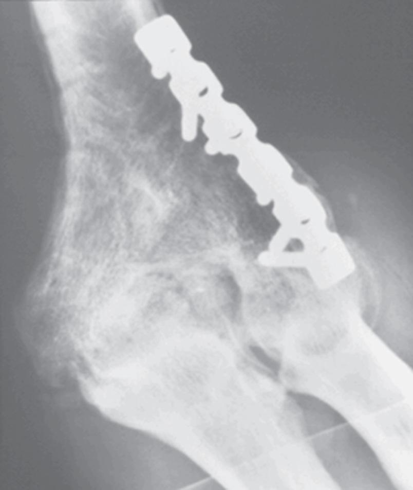 FIG 98.2, Loss of forearm rotation is common in patients with ankylosed elbows following spontaneous fusion from inflammatory conditions.