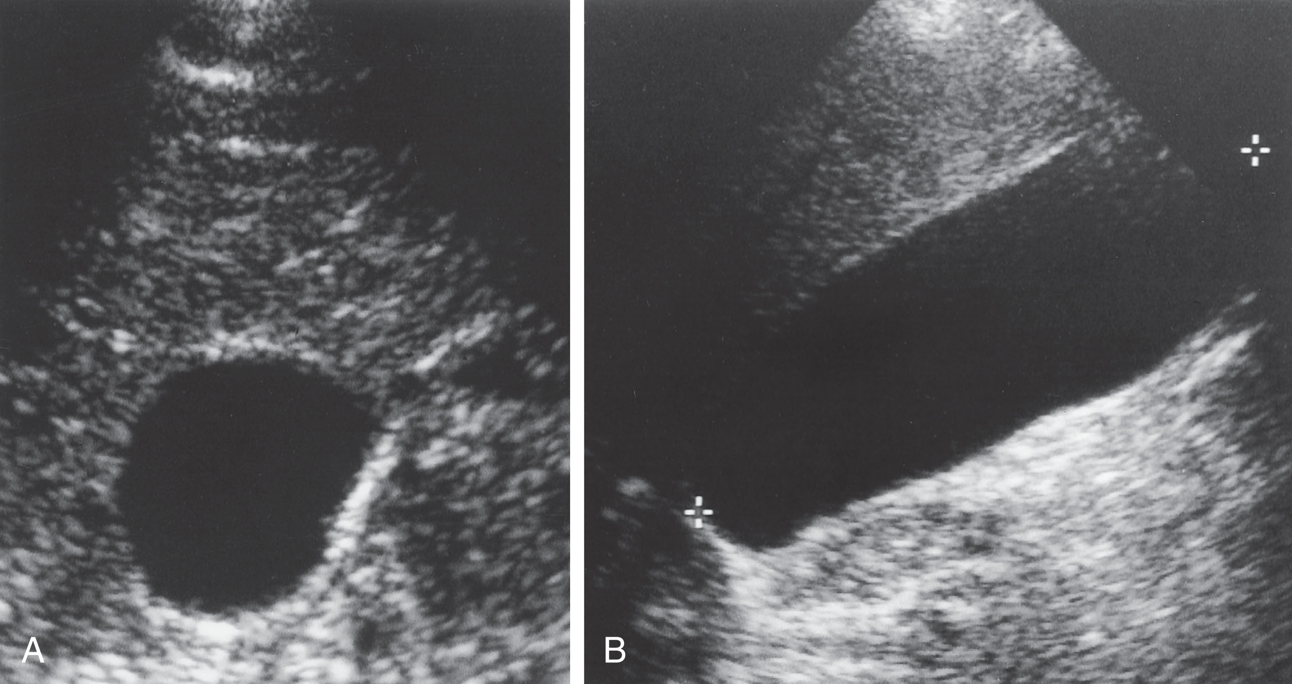 Fig. 10.11, (A) Transverse and (B) longitudinal scans of the distended gallbladder. The gallbladder size may be quite variable from patient to patient. A good rule of thumb is to compare the size of the gallbladder with the transverse view of the right kidney. The width should always be smaller ≤4 cm.