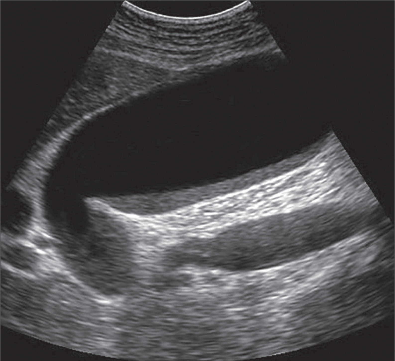 Fig. 10.12, Distention (hydrops) of the gallbladder may be found in patients who have been on intravenous fluids for several days or may be secondary to a mass or enlarged lymph nodes compressing the common bile duct.