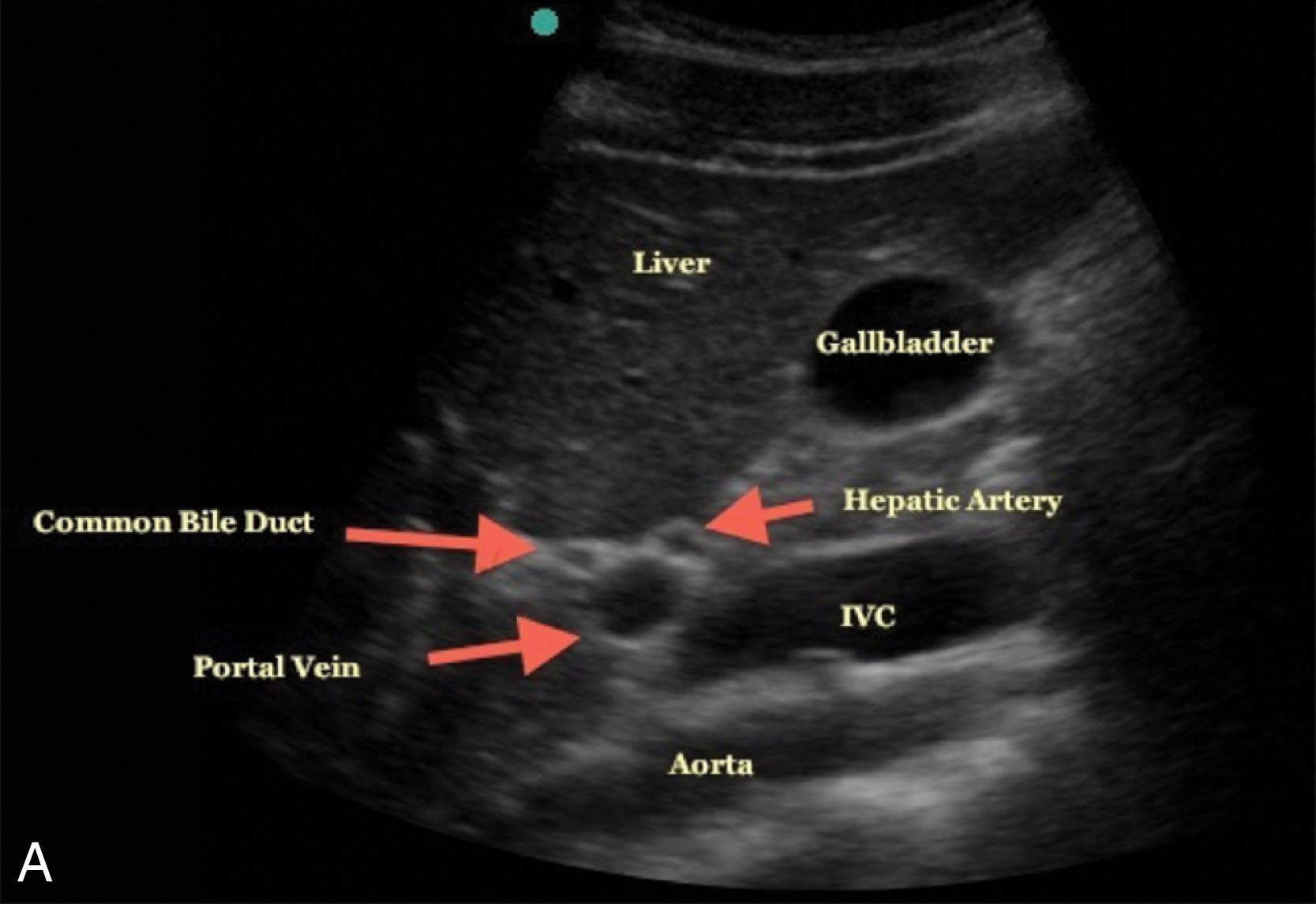 Fig. 10.13, Transverse oblique (A) and sagittal (B) views of the common bile duct. The transverse oblique view shows the portal triad with the portal vein posterior, the common duct anterior and lateral, and the hepatic artery anterior and medial. The sagittal view shows the common duct anterior to the main portal vein and tubular inferior vena cava.