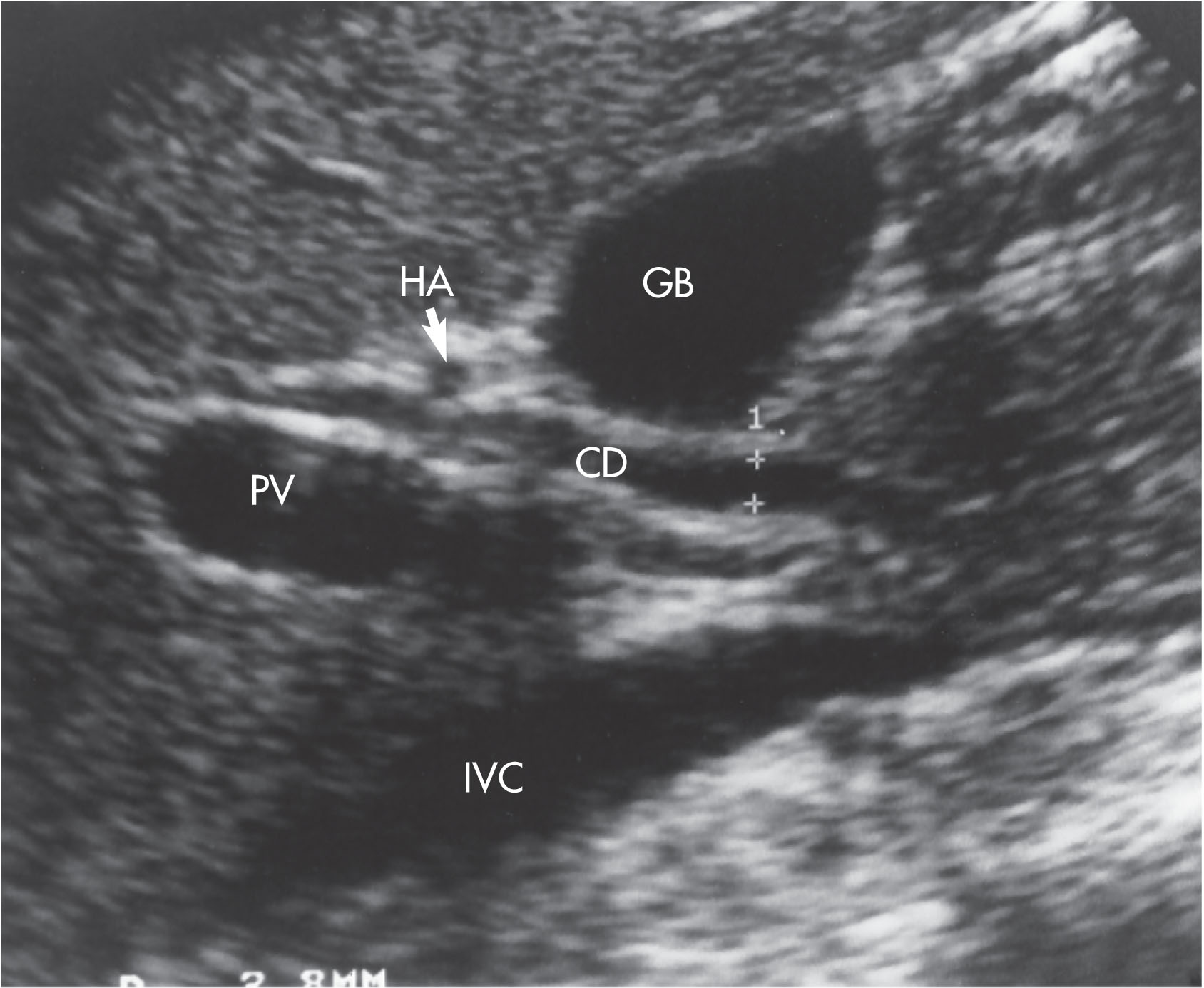 Fig. 10.15, On this sagittal image, the hepatic artery (HA) is shown anterior to the common duct (CD). The portal vein (PV) is anterior to the inferior vena cava (IVC). GB , Gallbladder.