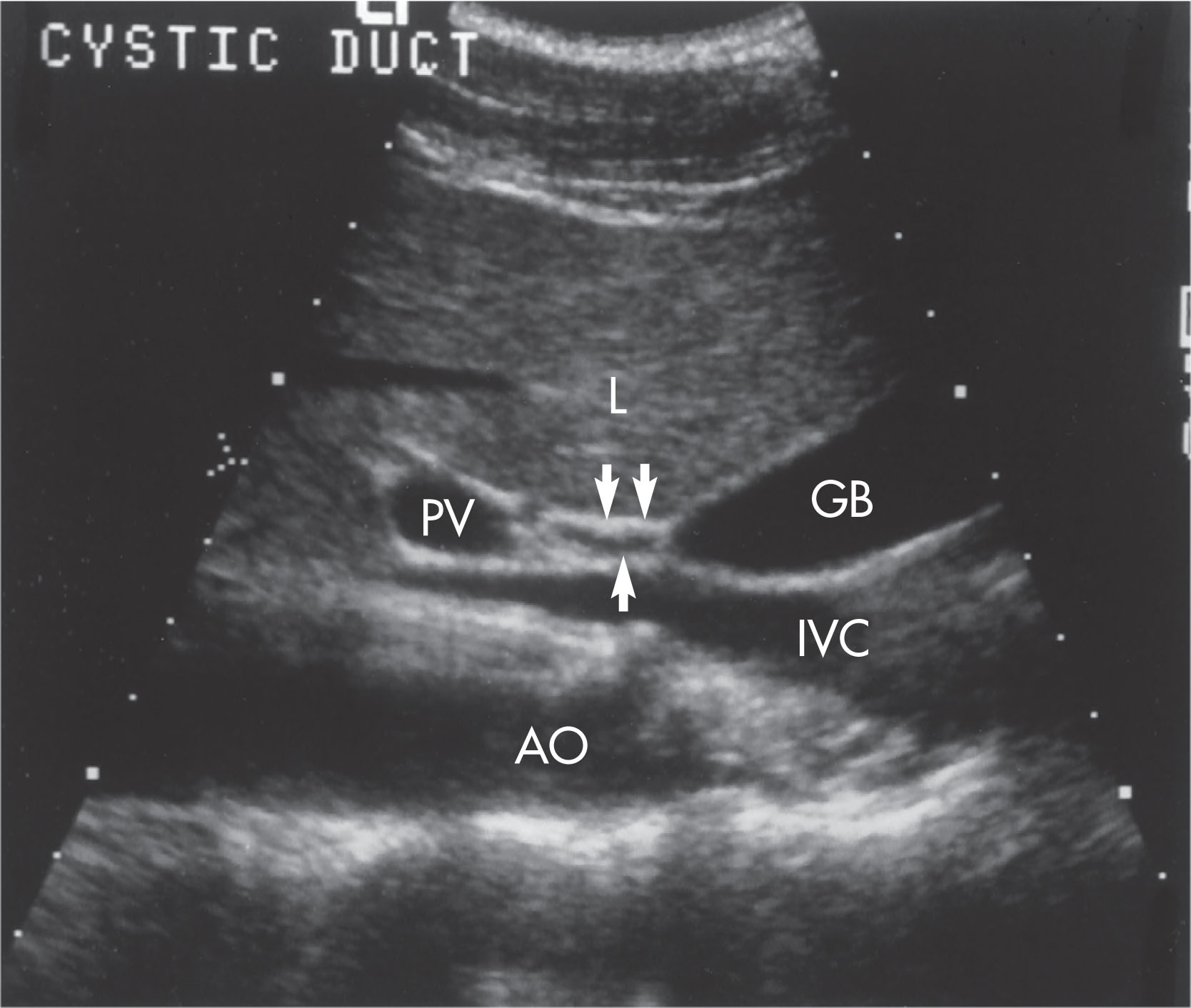 Fig. 10.16, The cystic duct is sometimes seen to arise from the neck of the gallbladder (arrows) . This coronal decubitus view shows the aorta (AO), inferior vena cava (IVC), gallbladder (GB), portal vein (PV), and liver (L).