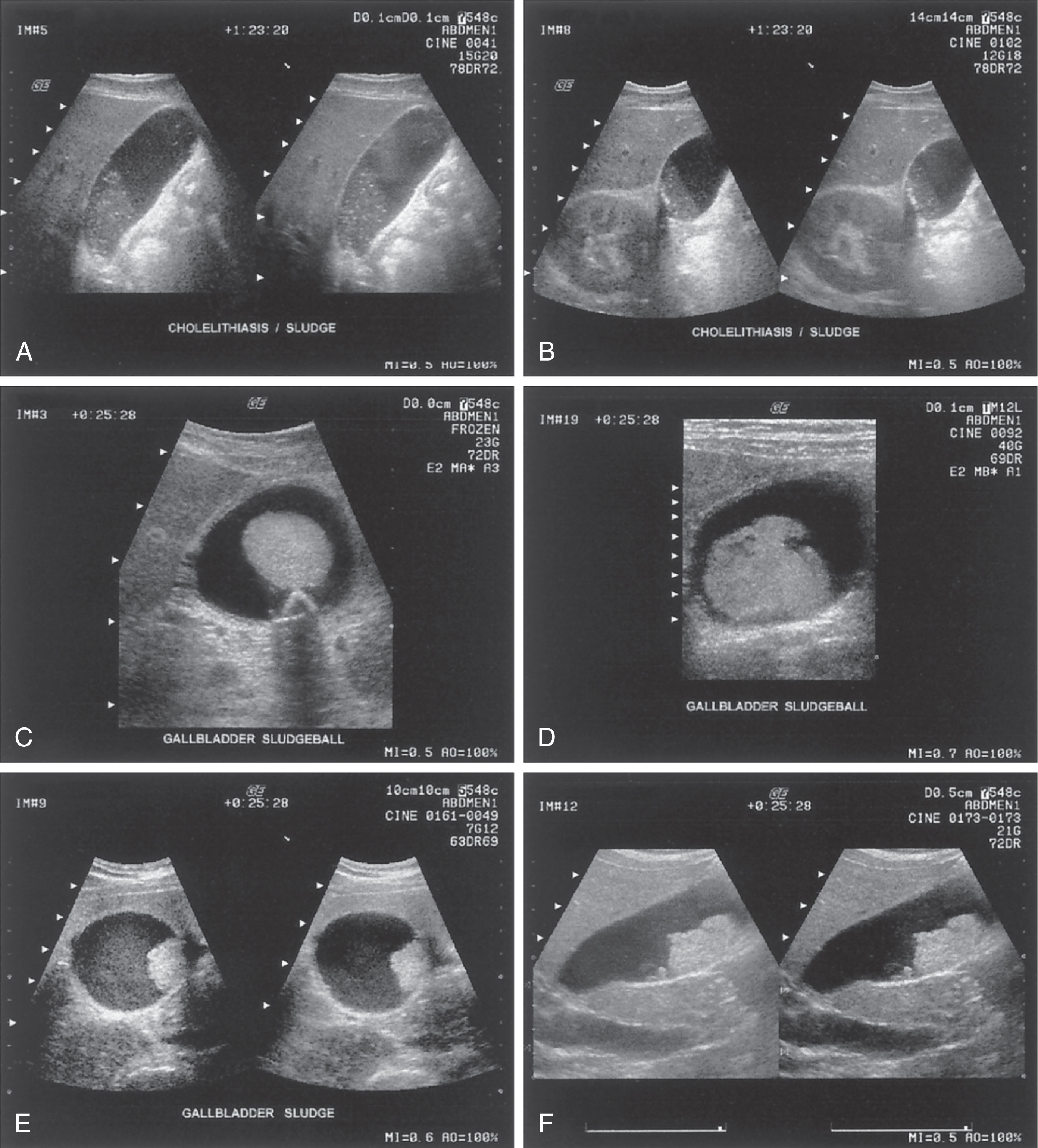 Fig. 10.17, (A–F) Multiple patterns of sludge within the gallbladder.