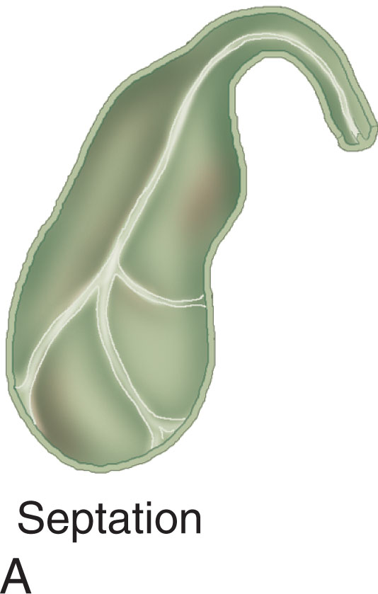 Fig. 10.7, Septations may be found in the gallbladder. Changes in patient position will show the septation to remain in the same position in the gallbladder. (A–B) Septated gallbladder shows a prominent gallbladder with multiple septations within the body. (C–D) The Phrygian cap is a variant in which part of the fundus of the gallbladder is bent back on itself. (E–F) The double gallbladder is seen infrequently; the recognition of two distinct sacs will confirm the diagnosis. (G–H) The folded gallbladder wall is seen in these longitudinal (left) and transverse (right) images.