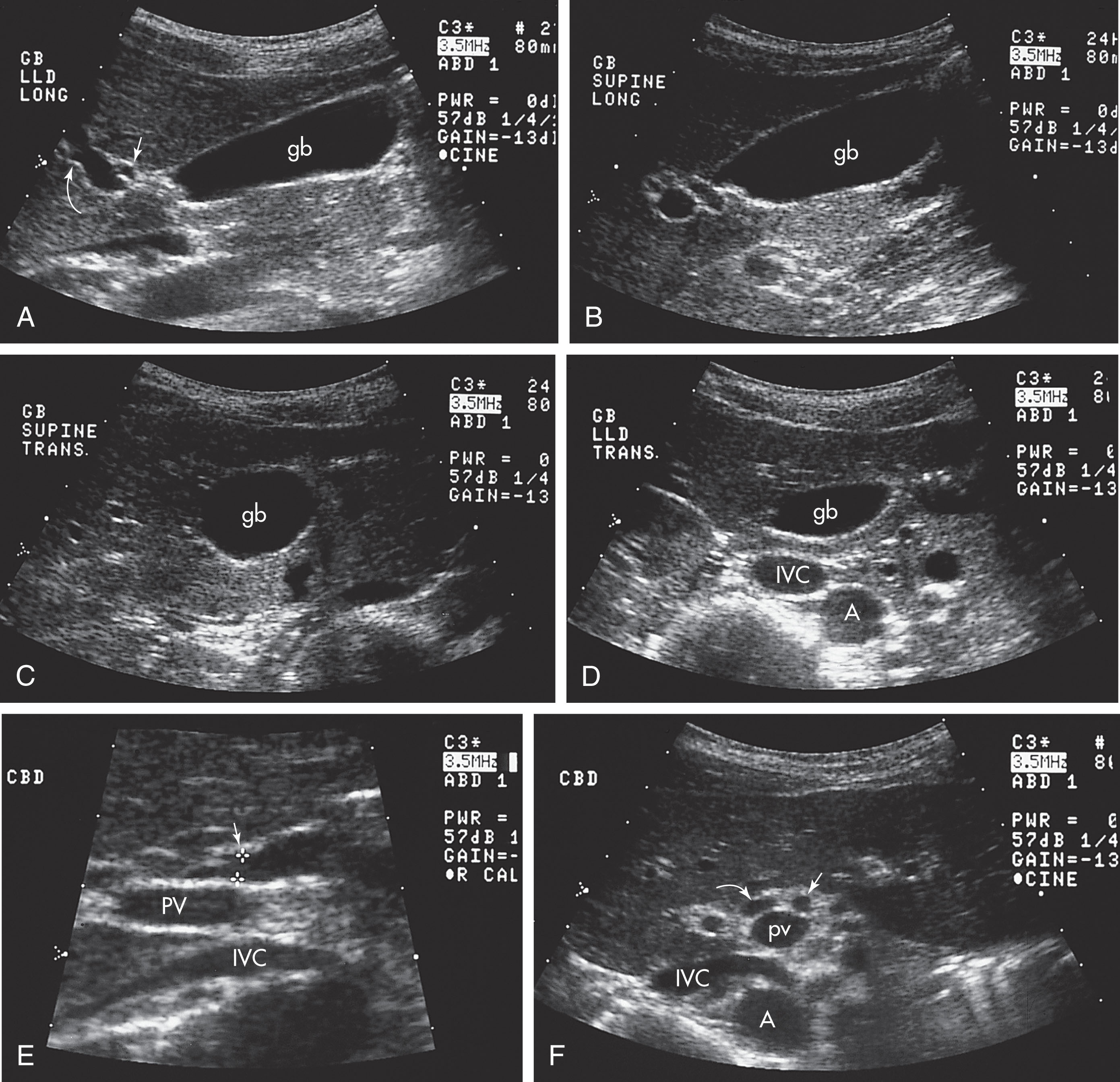 Fig. 10.9, (A) Longitudinal images of the gallbladder (gb), main lobar fissure (arrow) , and portal vein (curved arrow) . (B) Longitudinal image of gallbladder, including the neck. (C) Transverse image of gallbladder. (D) Transverse image of gallbladder, inferior vena cava (IVC), and aorta (A). (E) Longitudinal image of common bile duct (arrow) anterior to portal vein (PV) that lies anterior to the inferior vena cava. (F) Transverse image of portal tried in the center of the image: portal vein with common bile duct (curved arrow) anterior and lateral; hepatic artery (arrow) anterior and medial; inferior vena cava and aorta.