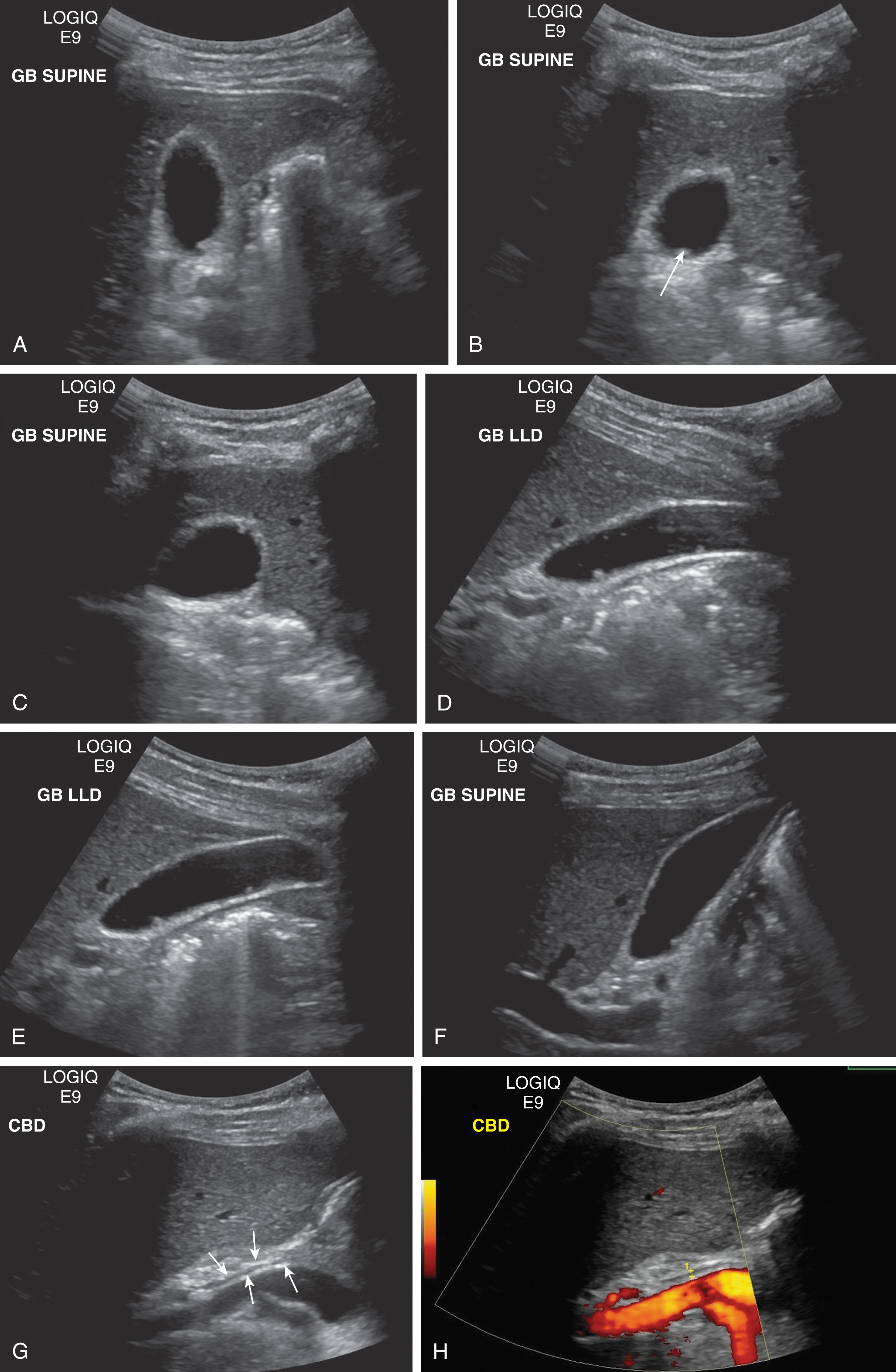 Fig. 10.10, (A–C) Supine transverse images of the gallbladder. Note the small echogenic adenoma attached to the posterior wall (arrow) . This does not move with alterations in patient position. (D–E) Left lateral decubitus images of the long axis of the gallbladder. (F–H) Supine longitudinal images of the gallbladder and common bile duct (arrows) .