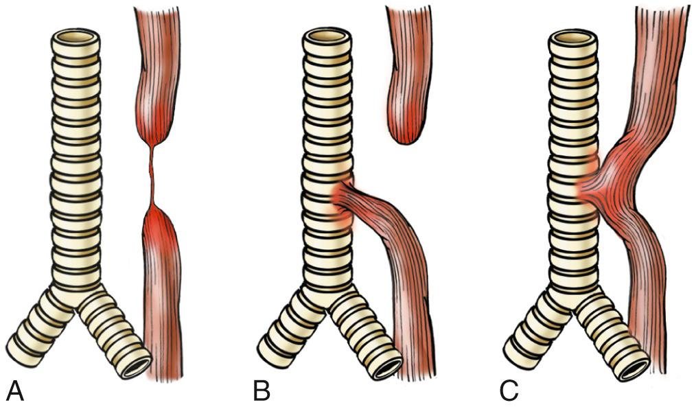 Figure 17.1, Esophageal atresia and tracheoesophageal fistula. (A) Blind upper and lower esophagus with thin cord of connective tissue linking the two segments. (B) Blind upper segment with fistula between lower segment and trachea. (C) Fistula (without atresia) between patent esophagus and trachea. The developmental anomaly shown in (B) is the most common.