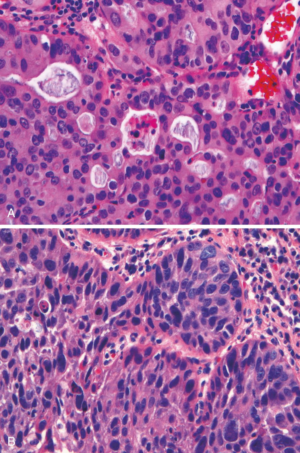 Figure 17.11, Esophageal cancer. (A) Esophageal adenocarcinoma organized into back-to-back glands. (B) Squamous cell carcinoma composed of nests of malignant cells that partially recapitulate the organization of squamous epithelium.