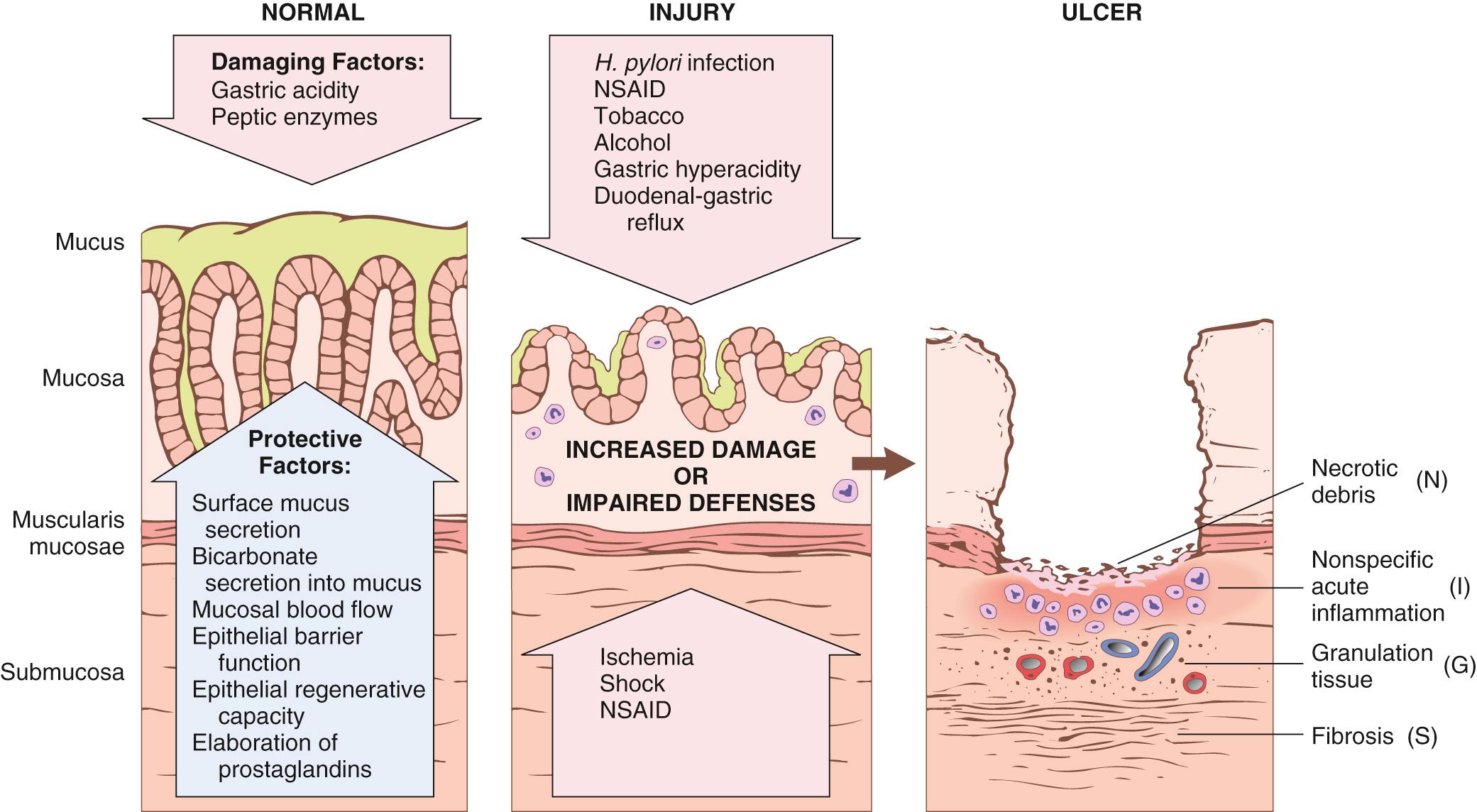 Figure 17.12, Mechanisms of gastric injury and protection. This diagram illustrates the progression from more mild forms of injury to ulceration that may occur with acute or chronic gastritis. Ulcers include layers of necrosis (N), inflammation (I), and granulation tissue (G), but a fibrotic scar (S), which takes time to develop, is present only in chronic lesions. NSAID, Non-steroidal anti-inflammatory drug.