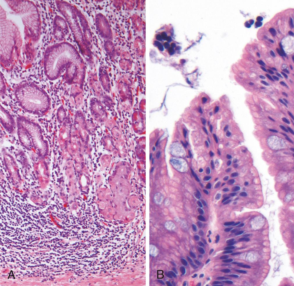 Figure 17.14, Autoimmune gastritis. (A) Low-magnification image of gastric body demonstrating deep inflammatory infiltrates, primarily composed of lymphocytes, and glandular atrophy. (B) Intestinal metaplasia, recognizable as the presence of goblet cells within gastric foveolar epithelium.