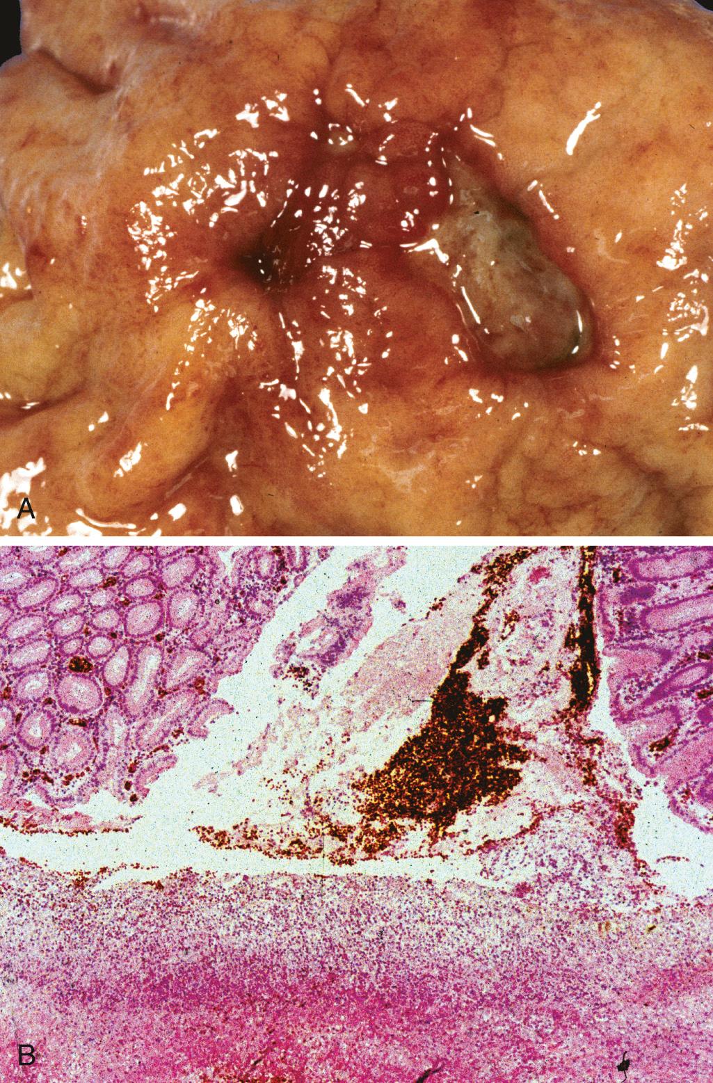 Figure 17.15, Acute gastric perforation in a patient presenting with free air under the diaphragm. (A) Mucosal defect with clean edges. (B) The necrotic ulcer base is composed of granulation tissue.