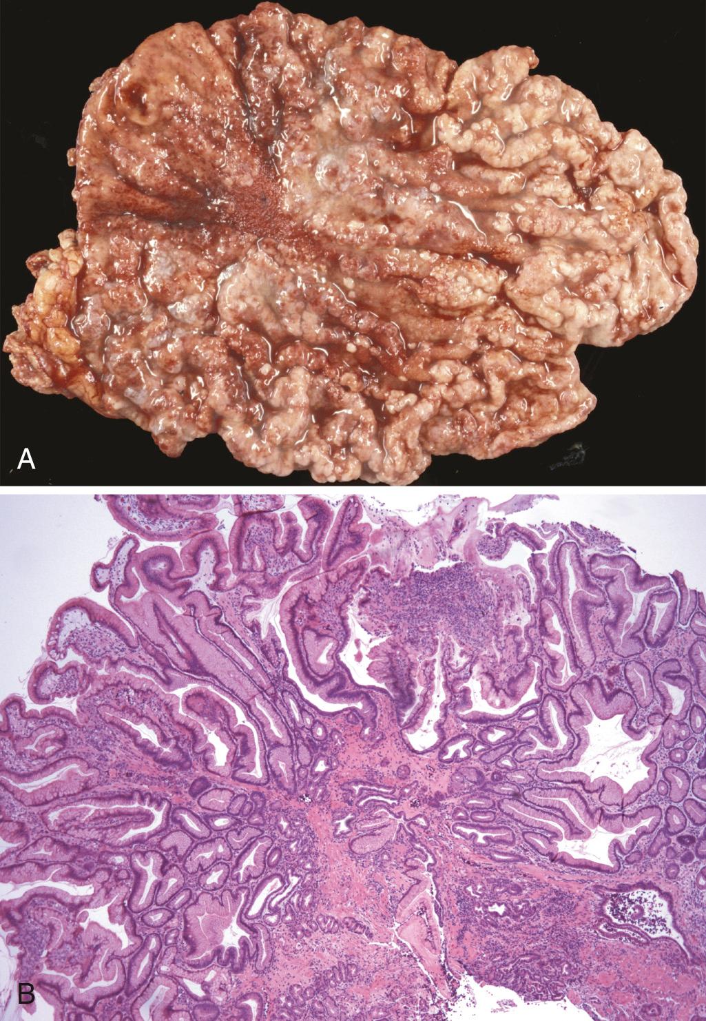 Figure 17.16, Ménétrier disease. (A) Marked hypertrophy of rugal folds. (B) Foveolar hyperplasia with elongated and focally dilated glands.