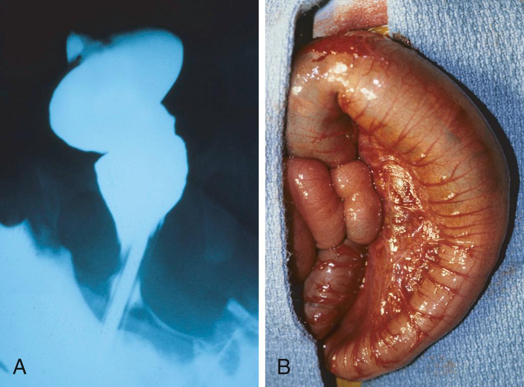 Figure 17.3, Hirschsprung disease. (A) Preoperative barium enema study showing constricted rectum (bottom of the image) and dilated sigmoid colon. (B) Corresponding intraoperative photograph showing constricted rectum and dilation of the sigmoid colon.