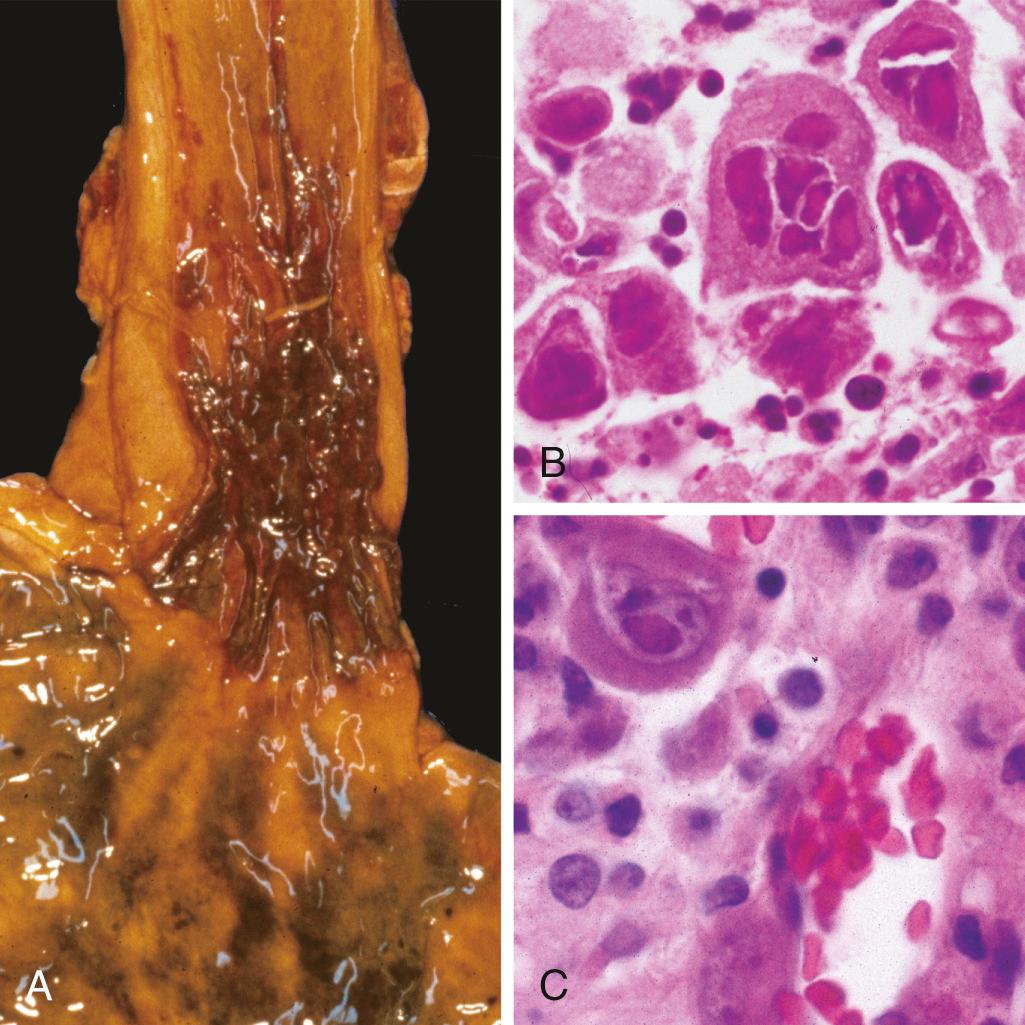 Figure 17.4, Viral esophagitis. (A) Postmortem specimen with multiple, overlapping herpetic ulcers in the distal esophagus. (B) Multinucleate squamous cells containing herpesvirus nuclear inclusions. (C) Cytomegalovirus-infected endothelial cells with nuclear and cytoplasmic inclusions.