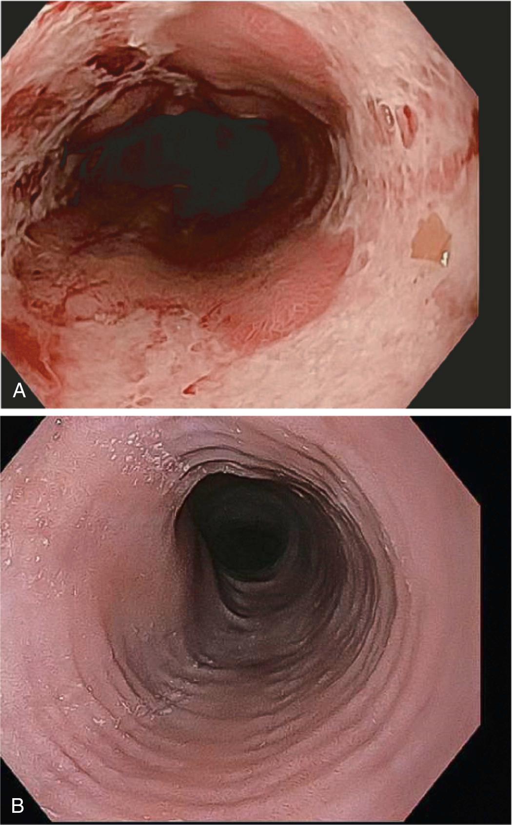 Figure 17.5, Esophagitis. (A) Endoscopic view of reflux esophagitis with multiple erosions within the squamous-lined esophagus, a metaplastic zone (Barrett esophagus, discussed later), and distal gastric mucosa. Note the tan islands of metaplastic epithelium within the white squamous mucosa. (B) The “feline” or “ringed” endoscopic appearance of the esophagus is typical of eosinophilic esophagitis.