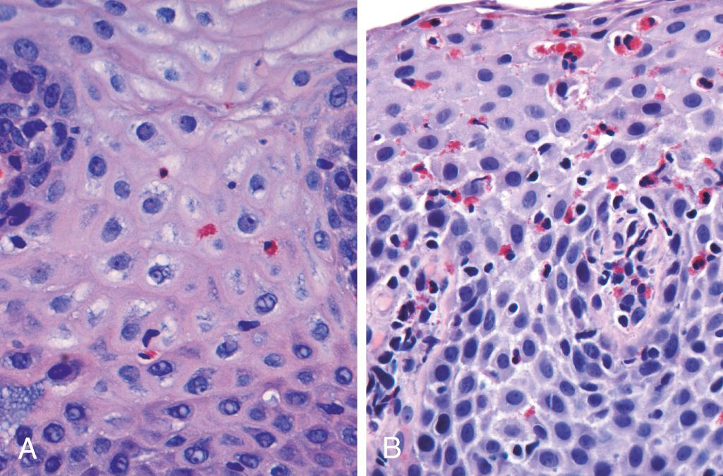 Figure 17.6, Esophagitis. (A) Reflux esophagitis with scattered intraepithelial eosinophils and mild basal zone expansion. (B) Eosinophilic esophagitis is characterized by numerous intraepithelial eosinophils.