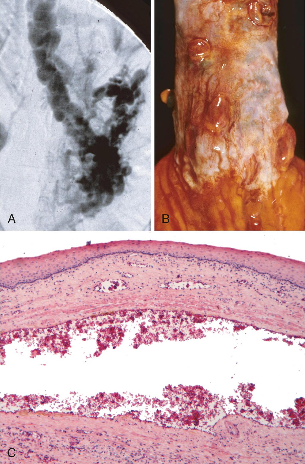 Figure 17.7, Esophageal varices. (A) Although no longer used as a diagnostic approach, this angiogram demonstrates several tortuous esophageal varices. (B) Collapsed varices are present in this postmortem specimen corresponding to the angiogram in (A). The polypoid areas represent previous sites of variceal hemorrhage that have been ligated with bands. (C) Dilated varices beneath intact squamous mucosa.