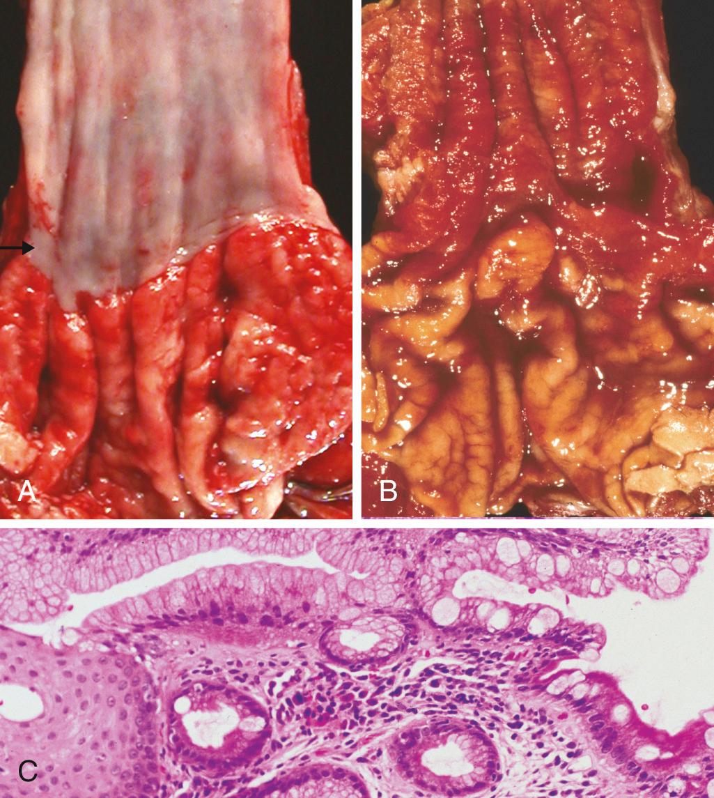 Figure 17.8, Barrett esophagus. (A) Normal gastroesophageal junction. (B) Barrett esophagus. Note the small islands of residual pale squamous mucosa within the Barrett mucosa. (C) Histologic appearance of the gastroesophageal junction in Barrett esophagus. Note the transition between esophageal squamous mucosa (left) and Barrett metaplasia, with abundant metaplastic goblet cells (right).