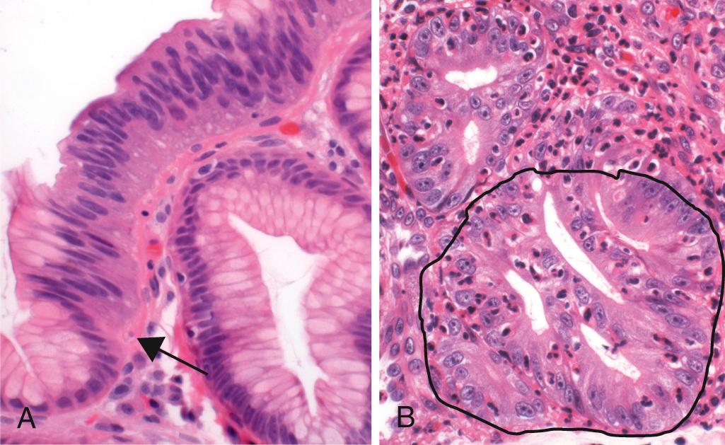 Figure 17.9, Dysplasia in Barrett esophagus. (A) Abrupt transition from metaplasia to low-grade dysplasia (arrow) . Note the nuclear stratification and hyperchromasia. (B) Architectural irregularities, including gland-within-gland, or cribriform, profiles in high-grade dysplasia (encircled) .