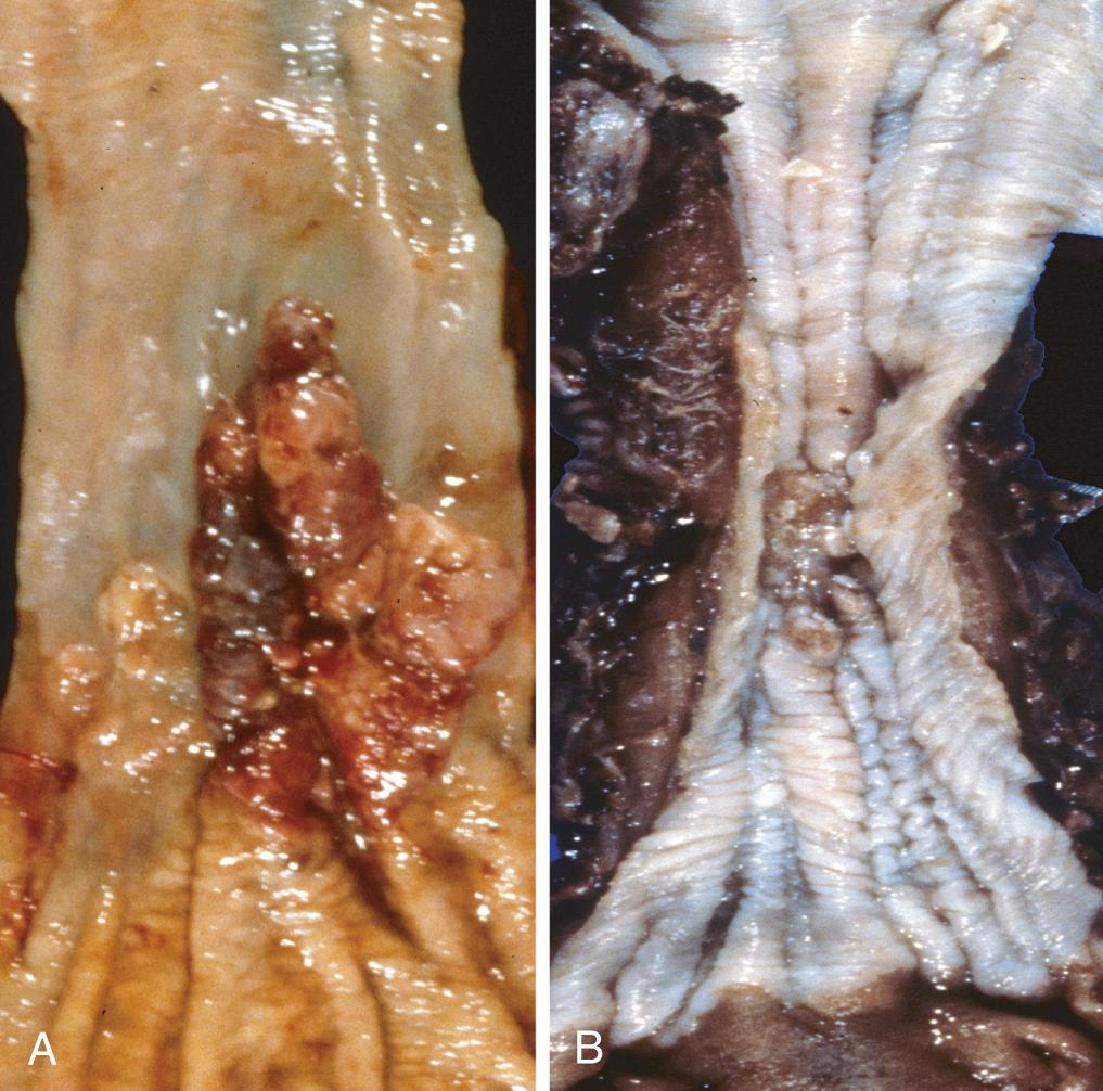 Figure 17.10, Esophageal cancer. (A) Adenocarcinoma usually occurs distally and, as in this case, often involves the gastric cardia. (B) Squamous cell carcinoma is most frequently found in the mid-esophagus, where it commonly causes strictures.