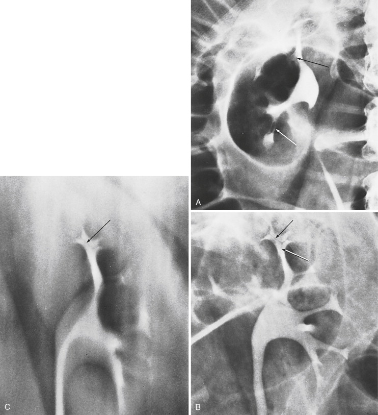 FIGURE 13-36, A, B, Mucosal folds seen within calyces and infundibula. C, Tomogram of left kidney shows the folds in the superior calyx. These folds do not indicate abnormality.