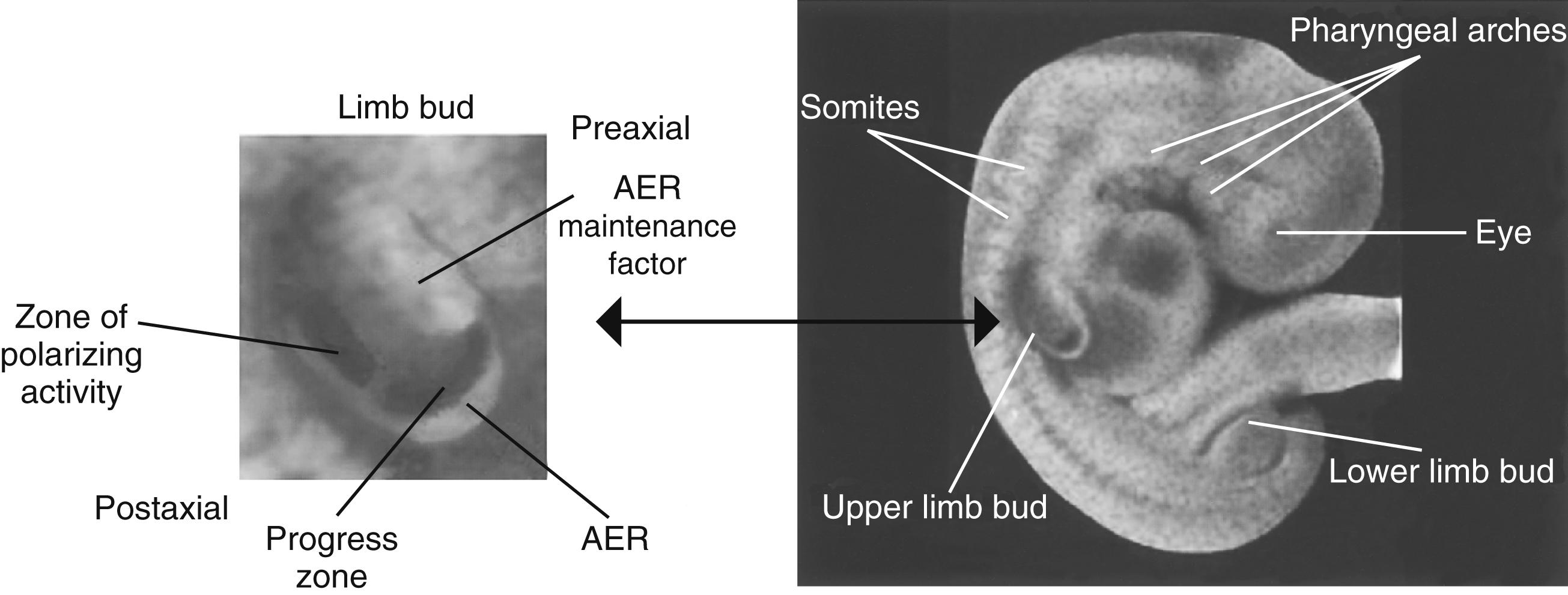 Fig. 137.1, A 5-week-old human embryo and enlargement of the upper and lower limb buds. The limb bud at this time is a jacket of ectoderm (apical ectodermal ridge [AER] ) covering undifferentiated mesenchymal cells (progress zone). The zone of polarizing activity, which is involved in anteroposterior patterning of the limb, is localized in a small area of mesoderm along the posterior border of the limb bud.