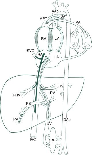 Fig. 14.1, Diagrammatic representation of normal fetal circulation. AAo, Ascending aorta; DA, ductus arteriosus; DAo, descending aorta; DV, ductus venosus; IVC, inferior vena cava; LA, left atrium; LHV, left hepatic vein; LV, left ventricle; MPT, main pulmonary trunk; P, placenta; PA, pulmonary artery; PS, portal system; PV, portal vein; RA , right atrium; RHV, right hepatic vein; RV, right ventricle; SVC, superior vena cava; UV, umbilical vein.