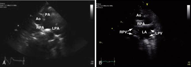 Fig. 14.11, Echocardiogram in the suprasternal short-axis view sweeping superior (A) to inferior (B)