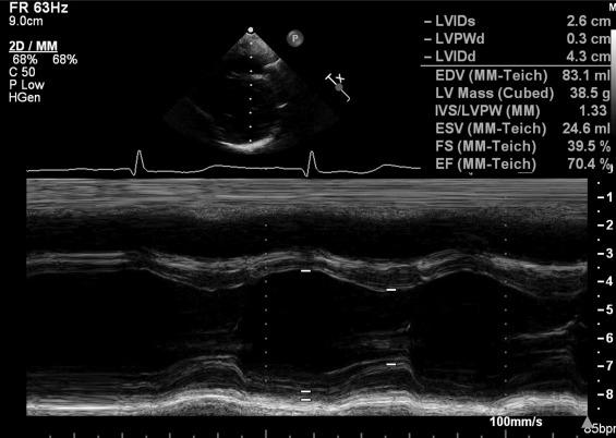 Fig. 14.12, M-mode analysis through the left ventricle with a normal shortening fraction of 39%. EF, ejection fraction; EDV, end diastolic volume; ESV, end systolic volume; FS, fractional shortening; IVS/LVPW, interventricular septum / left ventricular posterior wall; LVIDd, end-diastolic left ventricular internal dimension; LVIDs, end-systolic left ventricular internal dimension; LVPWd, end-diastolic left ventricular posterior wall thickness.