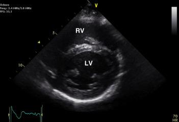 Fig. 14.13, Parasternal short axis at the level of the papillary muscle. LV, Left ventricle; RV, right ventricle.