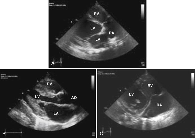 Fig. 14.5, Echocardiogram in the parasternal long-axis view sweeping anterior (A) to posterior (C) through the heart. Ao, Aorta; LA, left atrium; LV, left ventricle; PA, pulmonary artery; RA , right atrium; RV, right ventricle.